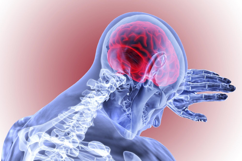 تشخیص و درمان سکته مغزی